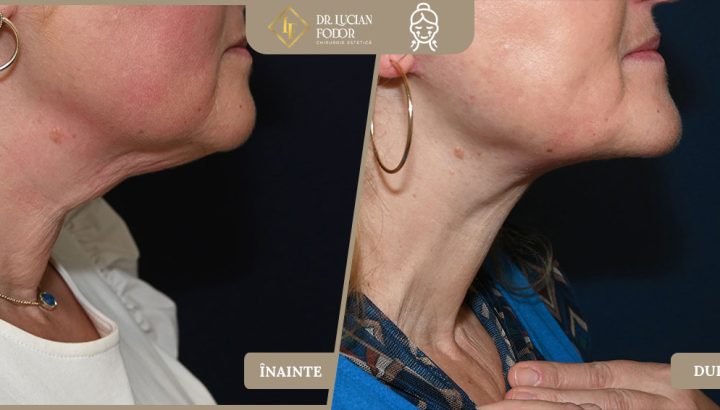 Cervical lift (neck lift) with deep muscle tightening and intermuscular fat removal – Case 20