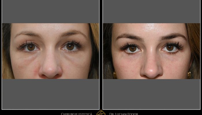 Blefaroplastie – Înlăturare ”festoons” sau pungi malare