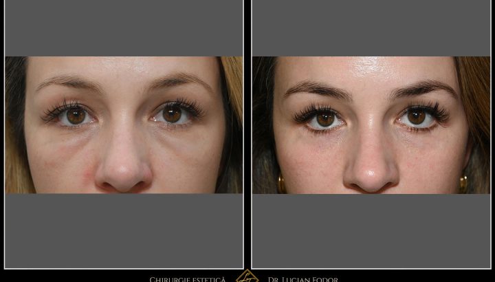 Blefaroplastie – Înlăturare ”festoons” sau pungi malare