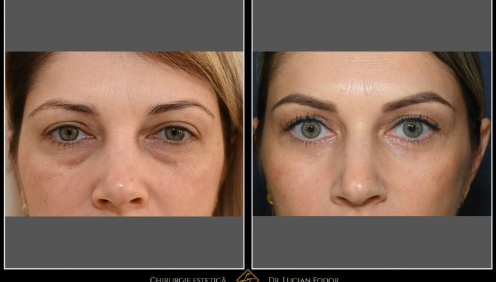 Lower blepharoplasty – restoring a youthful, refreshed look through advanced eyelid surgery
