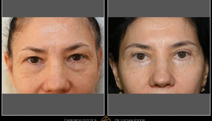 Blefaroplastie superioară și inferioară cu intarirea structurilor pleoapei inferioare – rejuvenarea completă a privirii si structurilor din jurul ochilor – Caz 35
