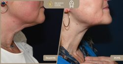 Lifting cervical (lifting de gât) cu întărirea planurilor musculare și îndepărtarea țesutului grasos - Caz 20 Foto 1