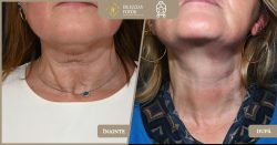 Lifting cervical (lifting de gât) cu întărirea planurilor musculare și îndepărtarea țesutului grasos - Caz 20 Foto 2