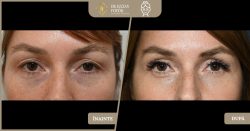 Blefaroplastie / Intinerire peoape- Caz 37 Foto 1
