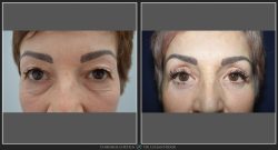 Blefaroplastie Caz 16 foto 1