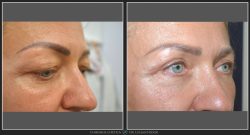 Blefaroplastie / Intinerire pleoape Caz 17 Foto 1