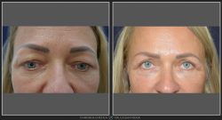 Blefaroplastie / Intinerire pleoape Caz 17 Foto 2