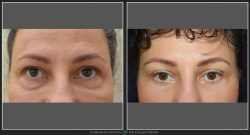 Blefaroplastie / Intinerire pleoape Caz 18 Foto 1