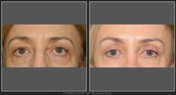 Blefaroplastie superioară / Lifting sprâncene - Caz 19 Foto 1