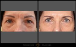 Blefaroplastie superioară / Lifting sprâncene - Caz 20 Foto 1
