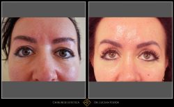 Blefaroplastie superioară / Lifting sprâncene - Caz 21 Foto 1