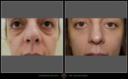 Blefaroplastie - Caz 23 Foto 1