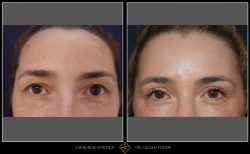 Blefaroplastie - Caz 24 Foto 1