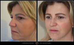 Blefaroplastie - Caz 26 Foto 1
