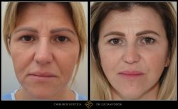 Blefaroplastie - Caz 26 Foto 2
