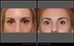 Blefaroplastie - Caz 27 Foto 1