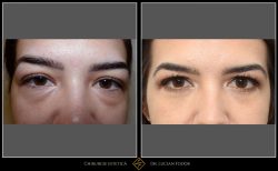 Blefaroplastie - Caz 28 Foto 1