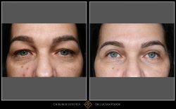 Blefaroplastie - Caz 29 Foto 1