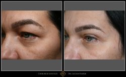 Blefaroplastie - Caz 29 Foto 2