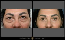 Blefaroplastie / Întinerire pleoape - Caz 31 Foto 1