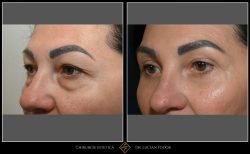 Blefaroplastie / Întinerire pleoape - Caz 31 Foto 2
