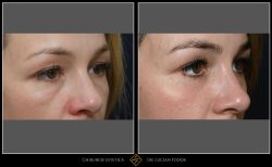 Blefaroplastie / Întinerire pleoape - Caz 32 Foto 2
