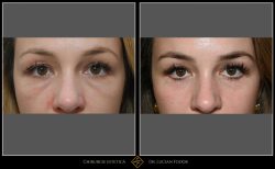 Blefaroplastie / Întinerire pleoape - Caz 32 Foto 1