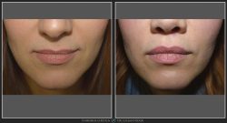 Mărire buze/Lip lift - Caz 24 Foto 1