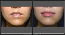 Mărire buze/Lip lift - Caz 25 Foto 1