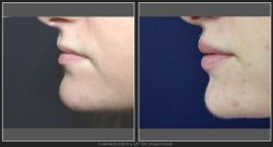 Mărire buze/Lip lift - Caz 26 Foto 2