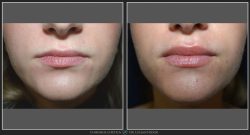 Mărire buze/Lip lift - Caz 26 Foto 1