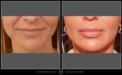 Mărire buze/Lip lift - Caz 28 Foto 1