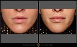 Mărire buze/Lip lift - Caz 29 Foto 1