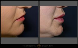 Mărire buze/Lip lift - Caz 31 Foto 1