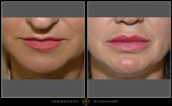 Mărire buze/Lip lift - Caz 31 Foto 2