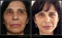 Lifting facial - Caz 16 Foto 2