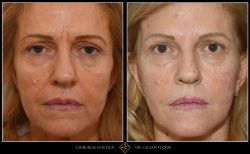 Lifting facial - Caz 18 Foto 2
