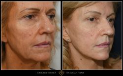 Lifting facial - Caz 18 Foto 3