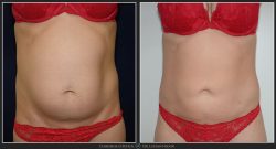 Liposuctie, lipoaspiratie Caz 26 Foto 2