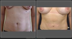 Liposuctie, lipoaspiratie Caz 29 Foto 2