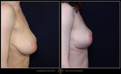 Micșorare și ridicare sâni - Caz 18 Foto 1