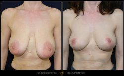 Micșorare și ridicare sâni - Caz 18 Foto 2