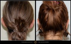 Otoplastie / operație urechi - Caz 15 Foto 1