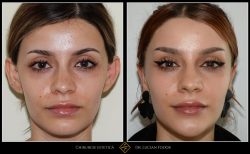 Otoplastie / operație urechi - Caz 15 Foto 2