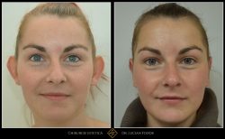 Otoplastie / operație urechi - Caz 16 Foto 1