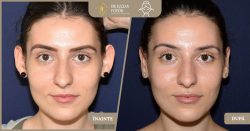 Otoplastie / Modelare-urechi - Caz 17 Foto 1