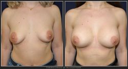 Ridicare Sani / Mastopexie - Caz 27 Foto 2
