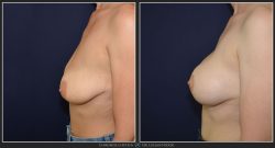 Ridicare sani / mastopexie Caz 28 Foto 1