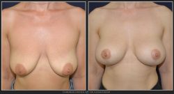 Ridicare sani / mastopexie Caz 28 Foto 2