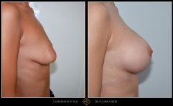 Ridicare sani / mastopexie Caz 29 Foto 1